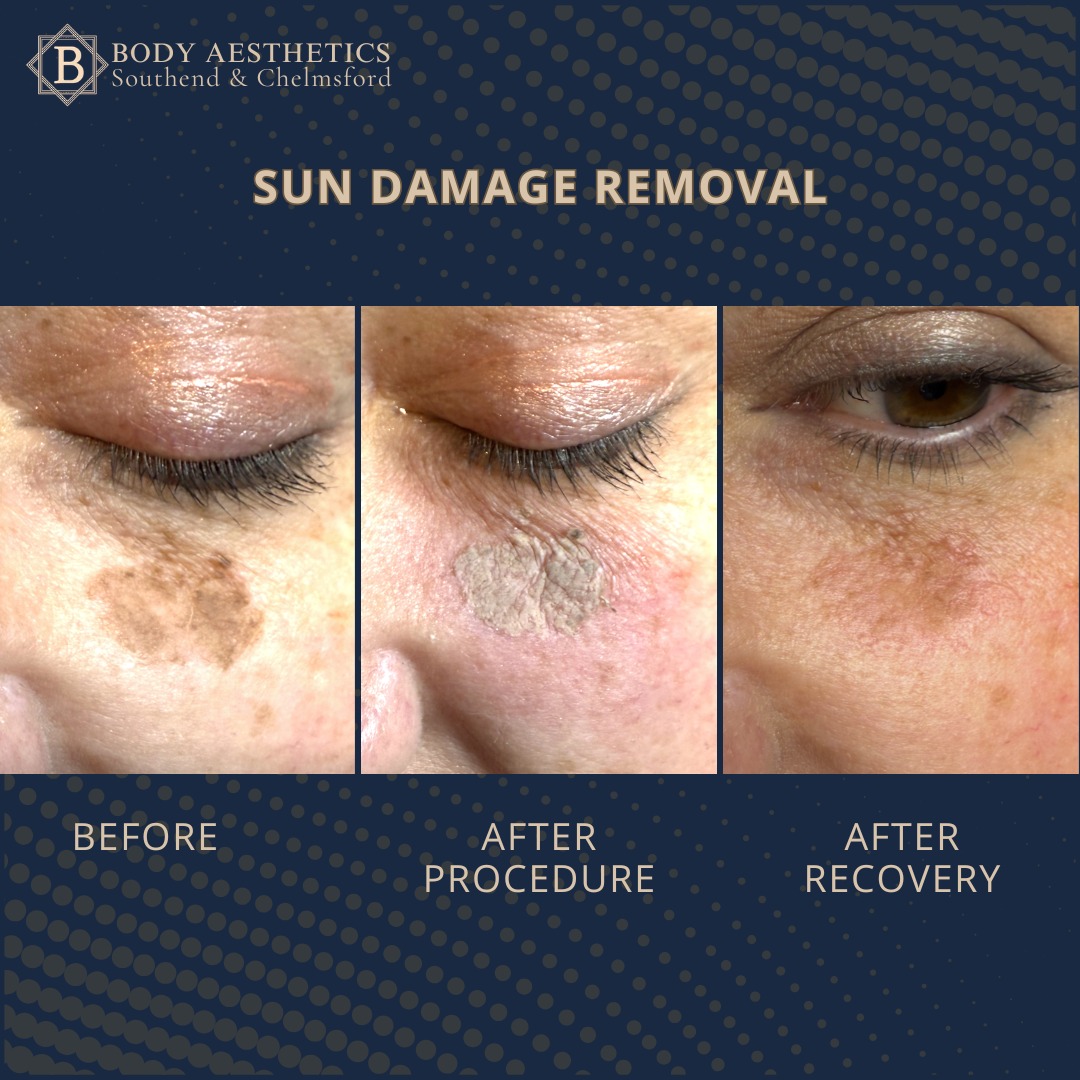 Laser Clinic Southend - Body Aesthetics - Laser Clinic Southend - Body Aesthetics